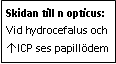 Text Box: Skidan till n opticus: Vid hydrocefalus och ↑ICP ses papillödem